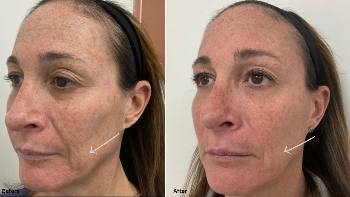 Contouring and Softening