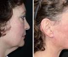 Clearing the Confusion About Facelift Surgery