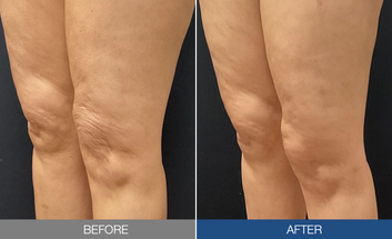 sofwave study results