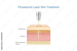 Picosecond laser