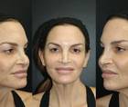 Healing Post CO2 Laser Using MTP Technology
