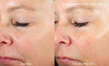 AVAVA FDA approval wrinkles