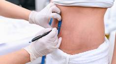 Topical Carboxytherapy for Latrogenic Skin Burns Following Liposuction
