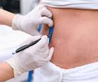 Topical Carboxytherapy for Latrogenic Skin Burns Following Liposuction