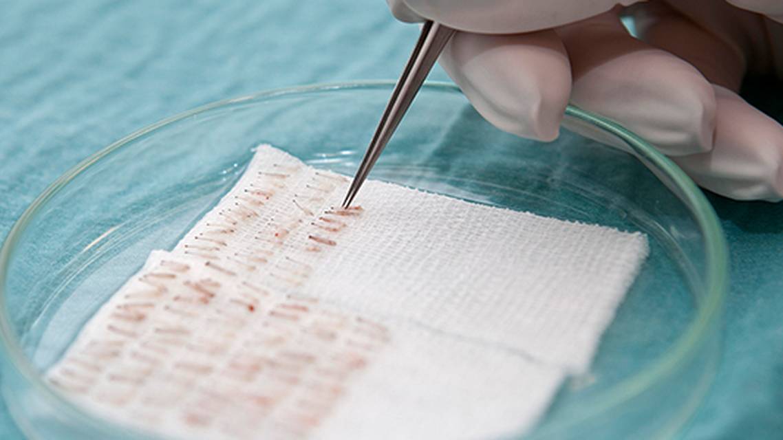 Turn Key Hair Restoration Requires Caution The Specialists Perspective
