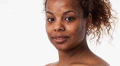Laser Therapy Advancements Acne Scarring for Skin of Color