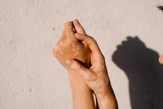 vitiligo