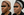 Figures 1 and 2. Before-and-after photographs of a patient who received 3 syringes of microdroplet HA 6 weeks apart for overall improvement of skin tone.