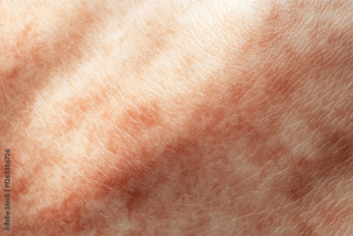Hyperpigmentation