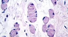 denervation
