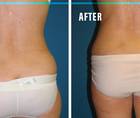 FLASH Technique A Quick Fix for Targeted Fat Pockets