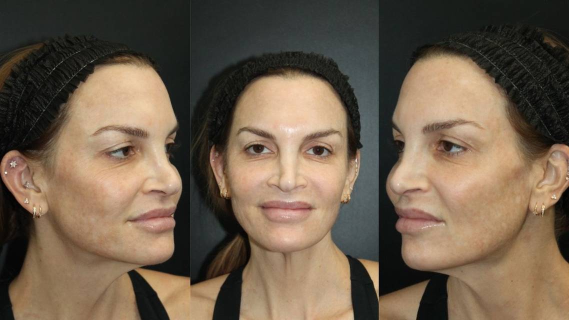 Healing Post CO2 Laser Using MTP Technology