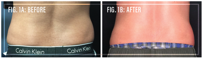 Deoxycholate Injection Lipolysis of Flank Fat in a Hea...