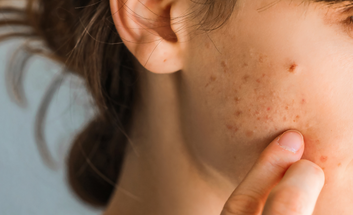 modern aesthetics acne