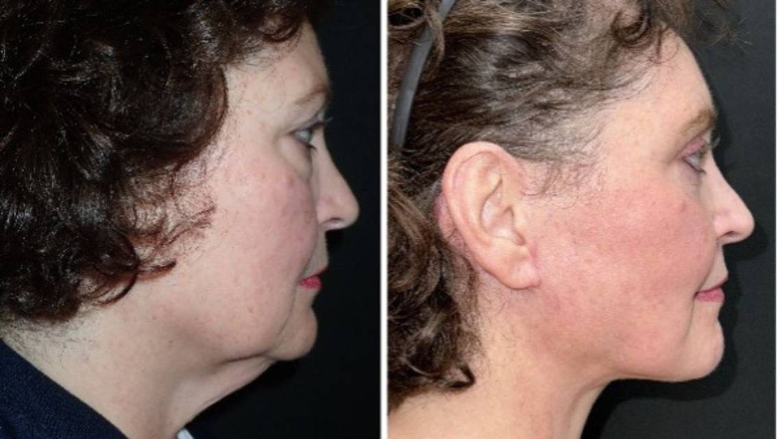 Clearing the Confusion About Facelift Surgery