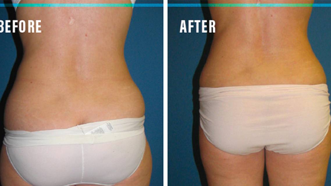 FLASH Technique A Quick Fix for Targeted Fat Pockets