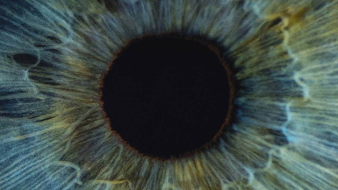 Permanent Iris Color Change