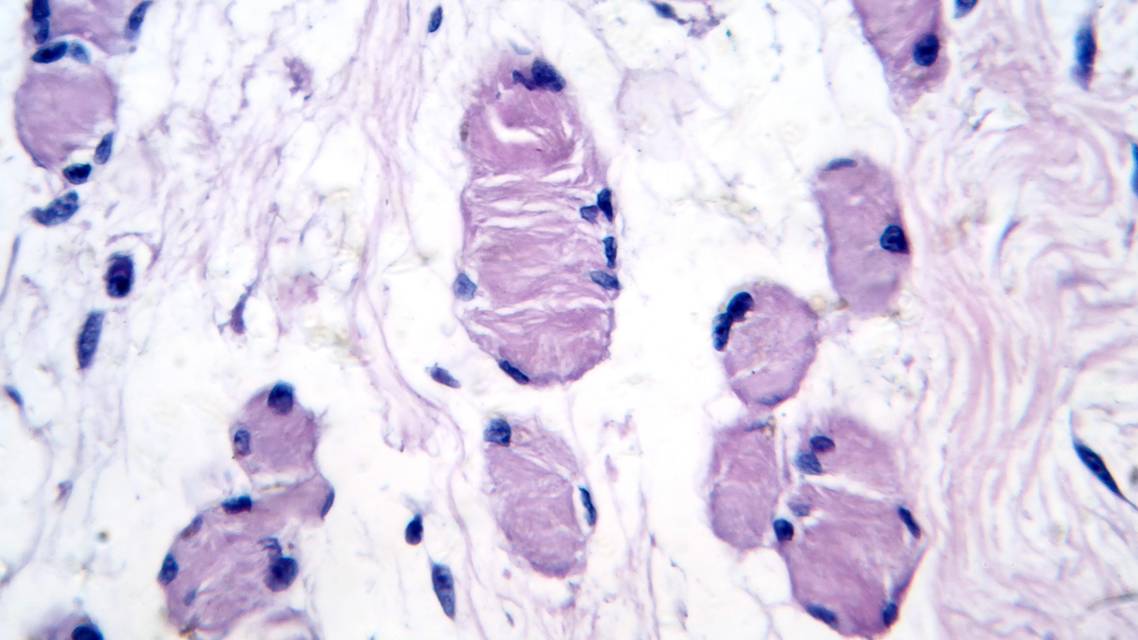 denervation
