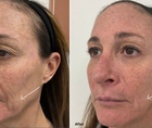 Contouring and Softening