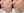 Fig 3: Dr. Nichols’ customized treatment plan for this patient included 9 treatments over 1 year. The treatments were done in a series of 3 AviClear, 3 chemical peels, and 3 facials.