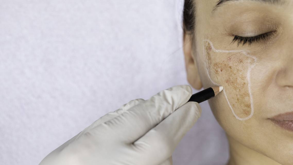 hyperpigmentation