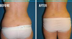 FLASH Technique A Quick Fix for Targeted Fat Pockets
