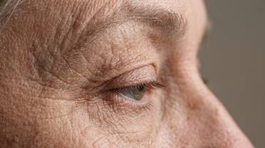 Periorbital wrinkles