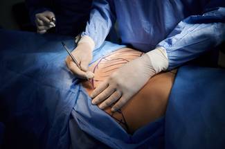 abdominoplasty