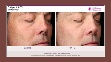 candela medical study