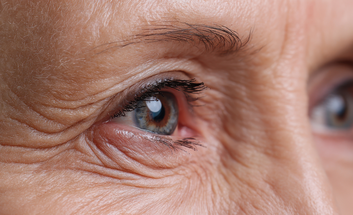 Lower Blepharoplasty