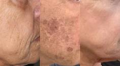Combination Treatment Focused on a Noninvasive Approach to Facial Rejuvenation