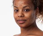 Laser Therapy Advancements Acne Scarring for Skin of Color