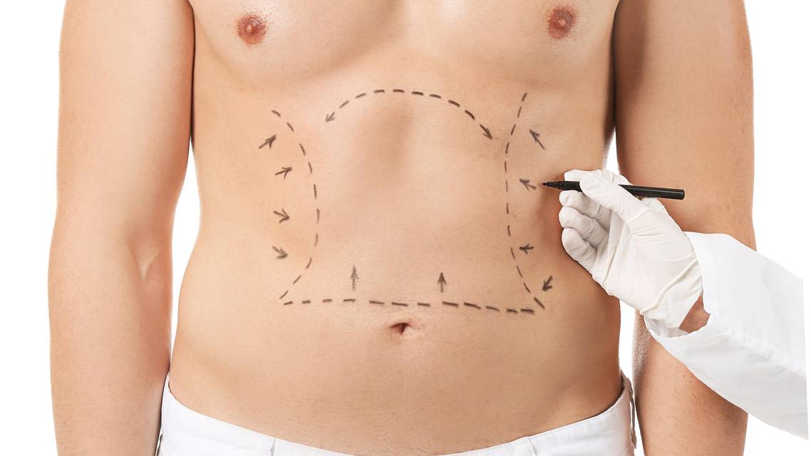 liposculpting