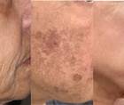 Combination Treatment Focused on a Noninvasive Approach to Facial Rejuvenation