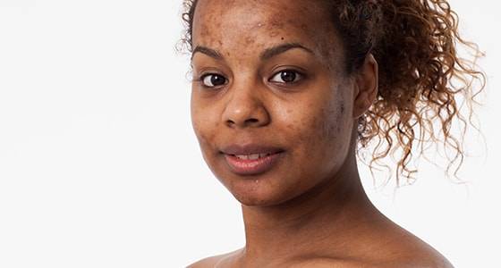 Laser Therapy Advancements Acne Scarring for Skin of Color
