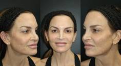 Healing Post CO2 Laser Using MTP Technology