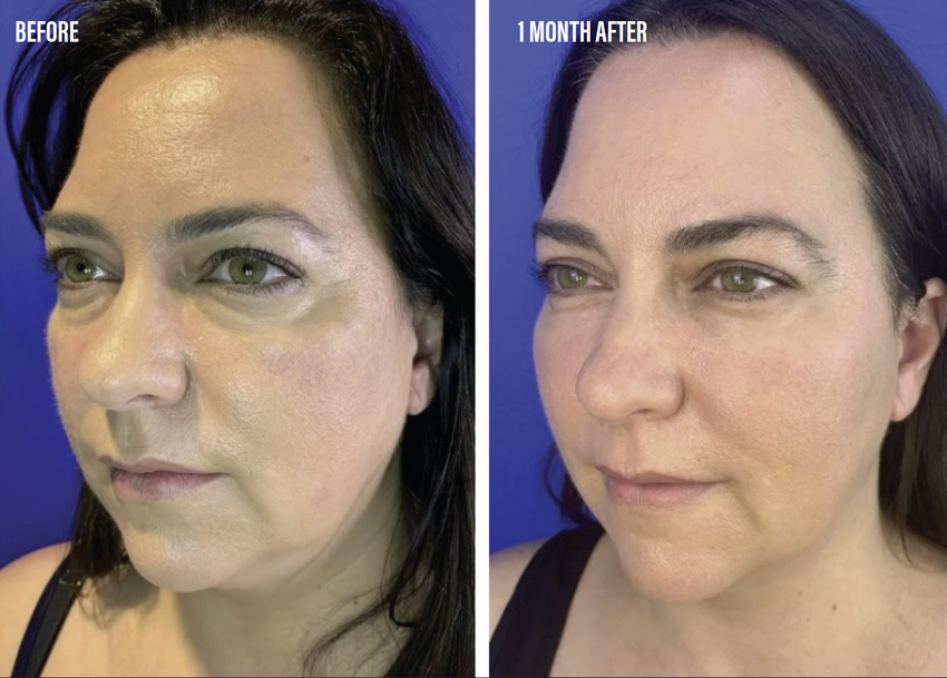 Combining Thread Lifting and Filler Injections