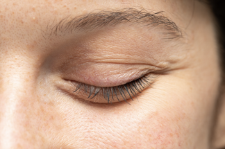 Blepharoplasty